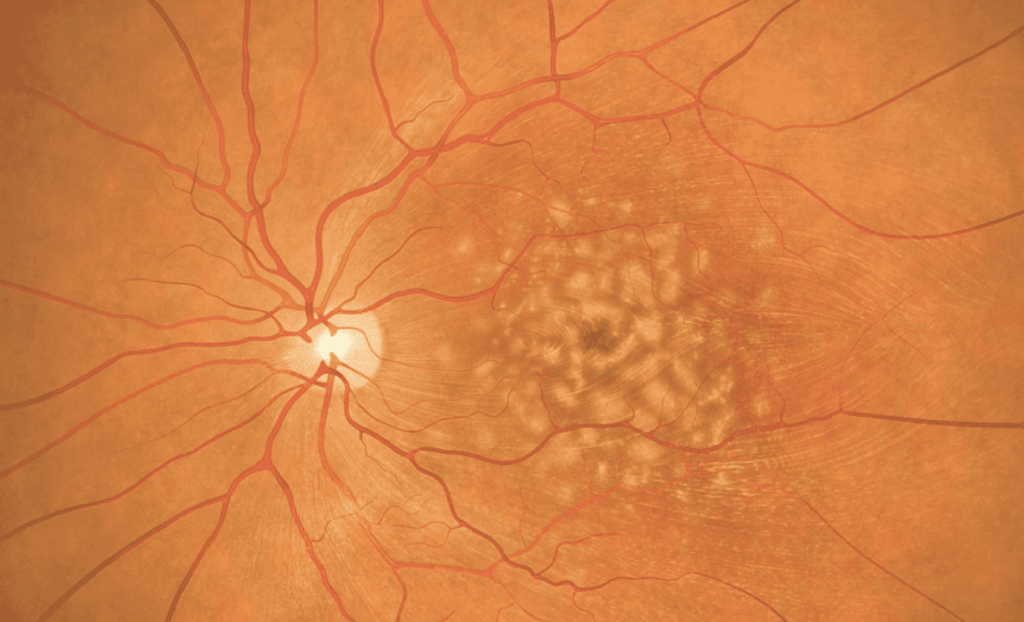 Quels sont les signes d'une rétinopathie ? Annecy Ophtalmo