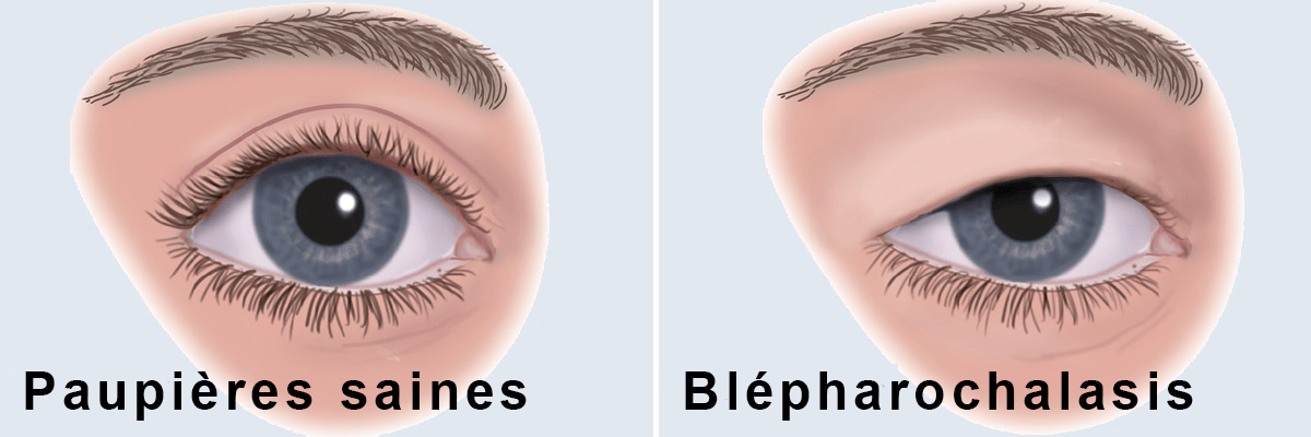 Blepharochalasis