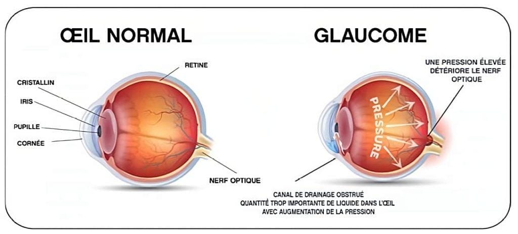 glaucome a angle ouvert