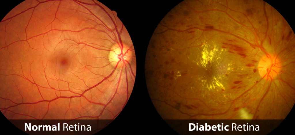 Comparaison Rétine Normale Et Rétinopathie Diabétique