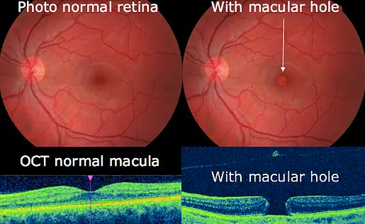 Comparaison Rétine Normale Et Trou Maculaire