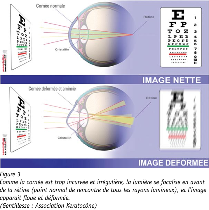 Schéma De La Déformation De La Vision Chez Un Patient Ayant Un Kératocône