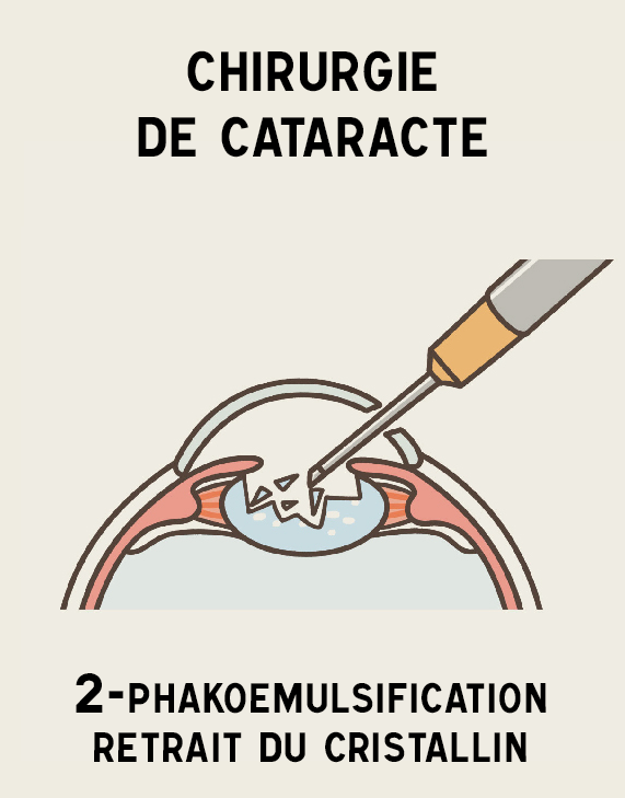 Illustration cataracte 2 Phakoemulsification