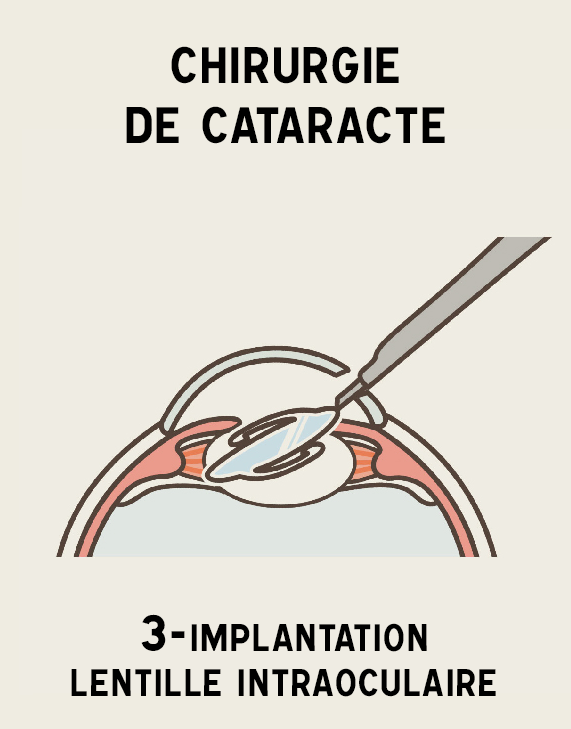 Illustration cataracte 3 Implantation IOL