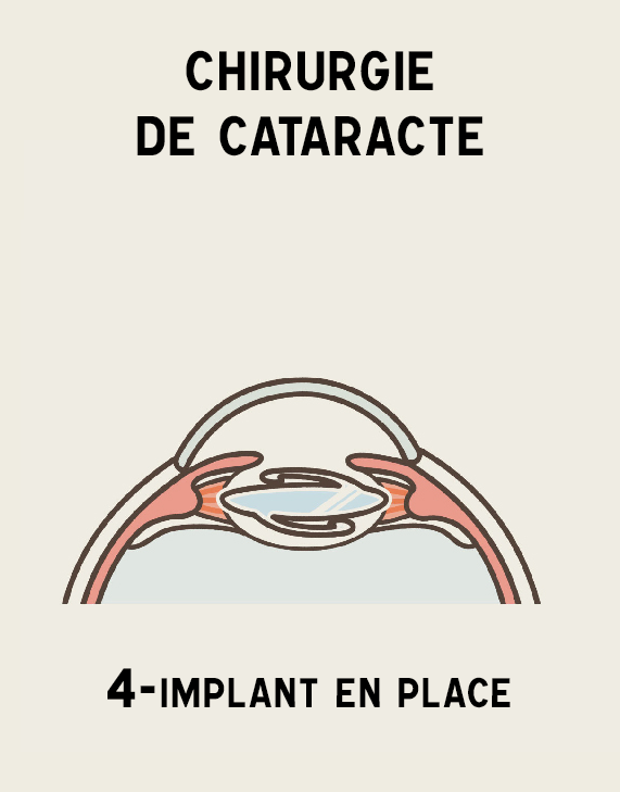 Illustration cataracte 4 Implant en place