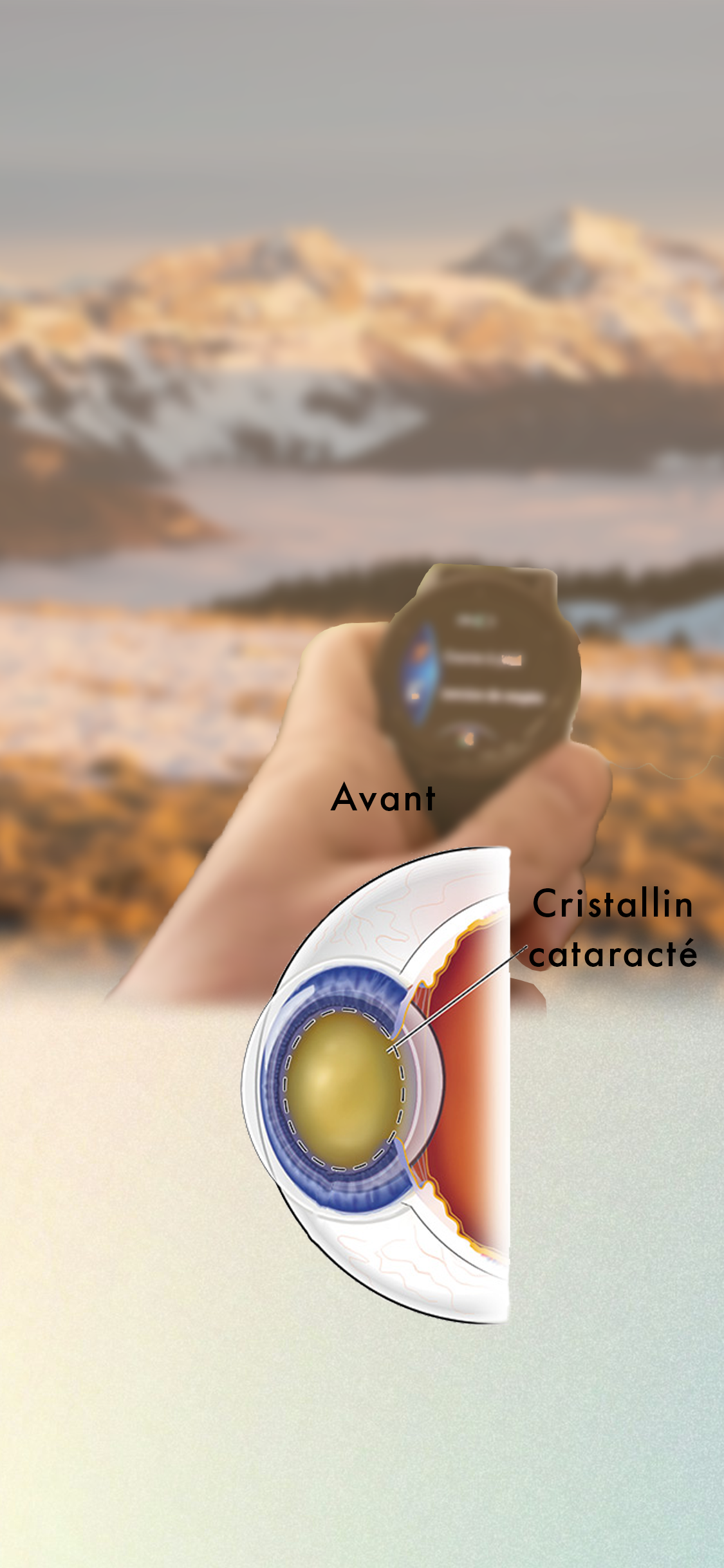 Implant Cataracte EDOF Cataracte