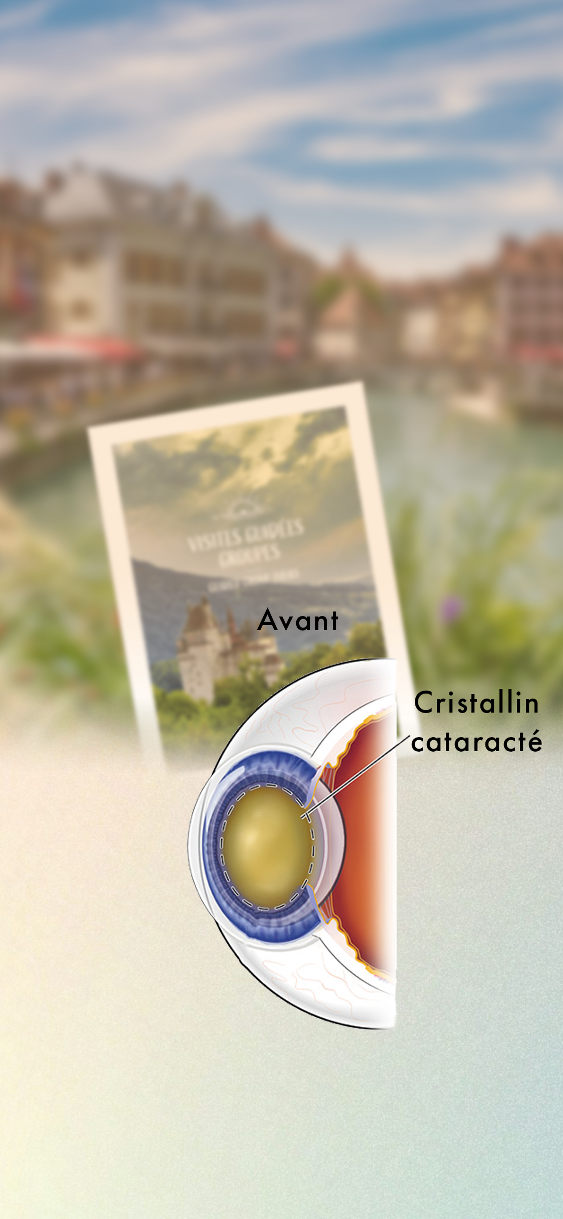 Implant Cataracte Multifocal Cataracte
