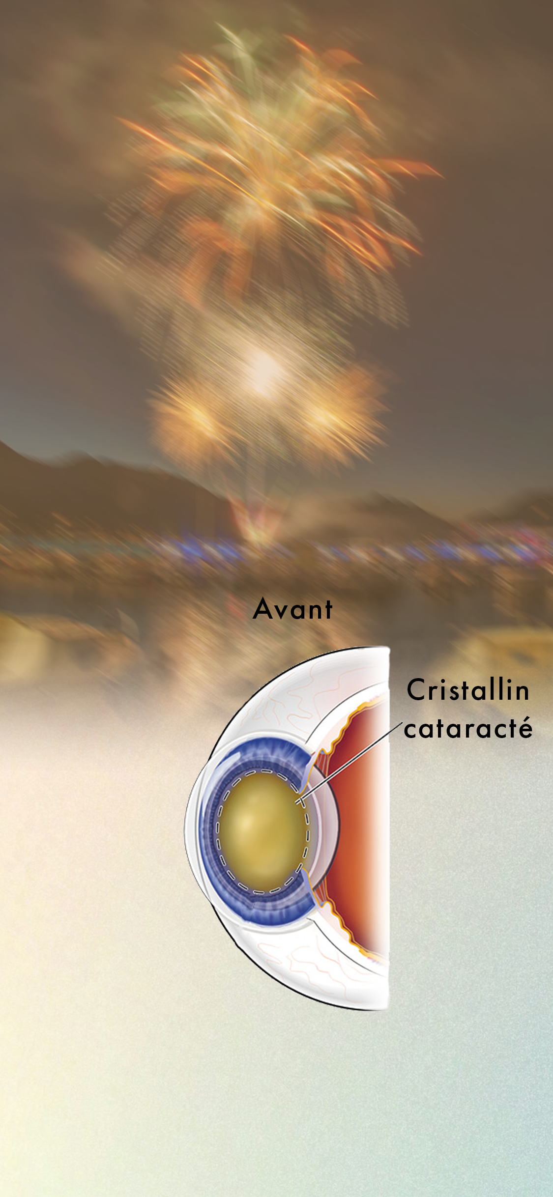 Implant Cataracte Torique Cataracte