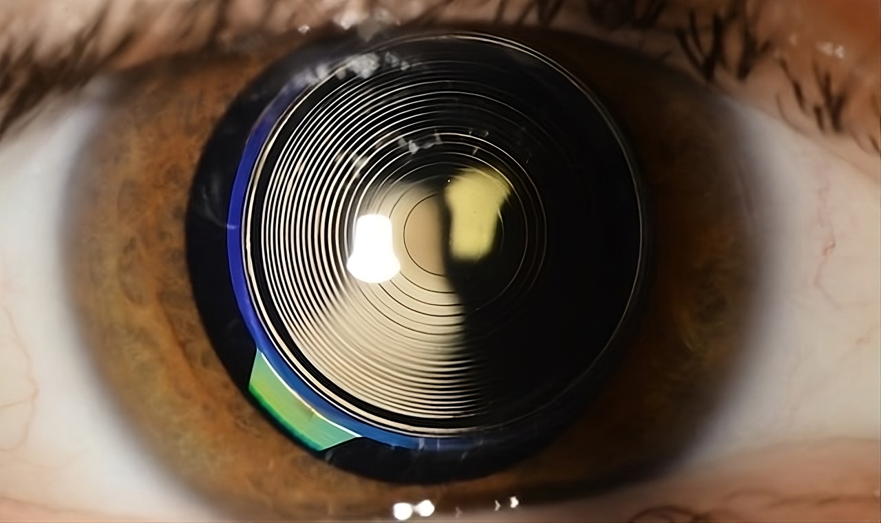 Implant multifocal