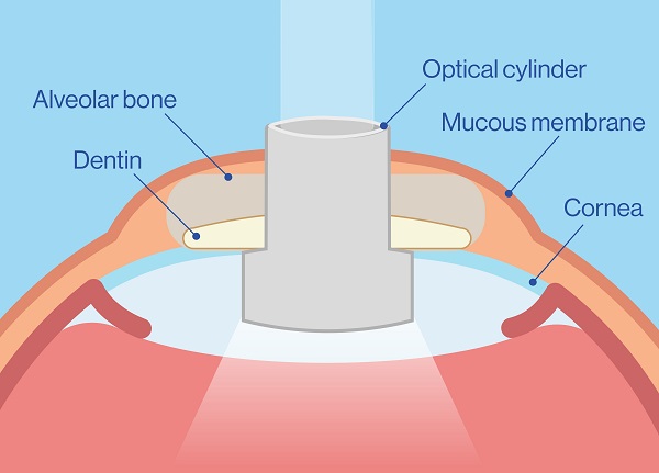 OSteo Odonto Keratoprothèse